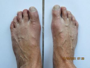 Dna moczanowa/podagra - po fonowaniu