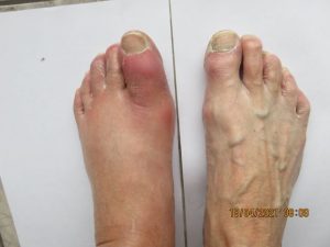 Dna moczanowa/podagra - przed fonowaniem